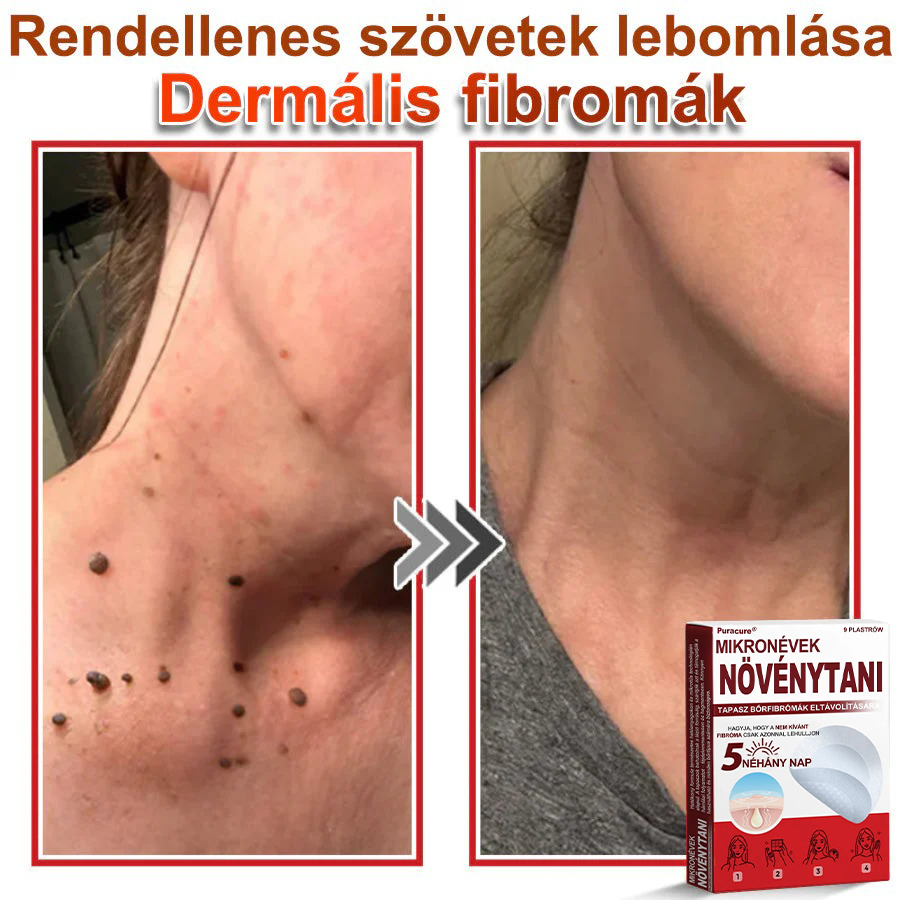 ✨PuraCure® Mikro-tűs botanikai bőrnövedék-eltávolító ✅✅Készült Magyarországon