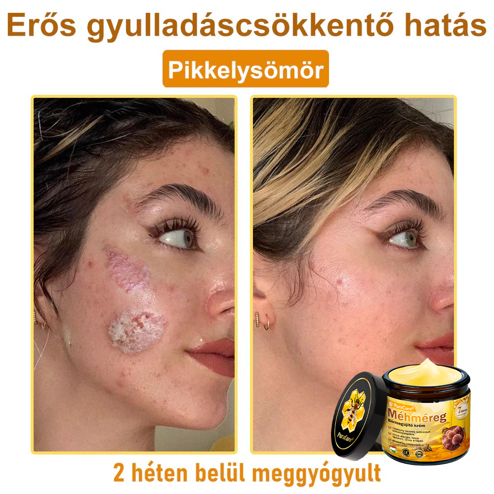 🔥🔥  𝐏𝐮𝐫𝐚𝐂𝐮𝐫𝐞® 𝐌é𝐡𝐦é𝐫𝐞𝐠 𝐁ő𝐫 𝐇𝐞𝐥𝐲𝐫𝐞á𝐥𝐥í𝐭ó 𝐊𝐫é𝐦 (👨‍⚕‍𝐂𝐄 𝐓𝐚𝐧ú𝐬í𝐭𝐯á𝐧𝐲)👍✅