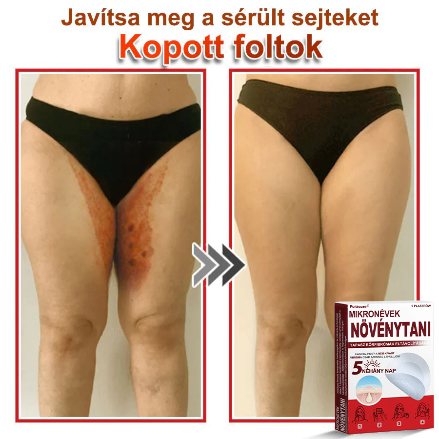 ✨PuraCure® Mikro-tűs botanikai bőrnövedék-eltávolító ✅✅Készült Magyarországon