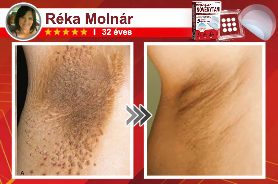 ✨PuraCure® Mikro-tűs botanikai bőrnövedék-eltávolító ✅✅Készült Magyarországon