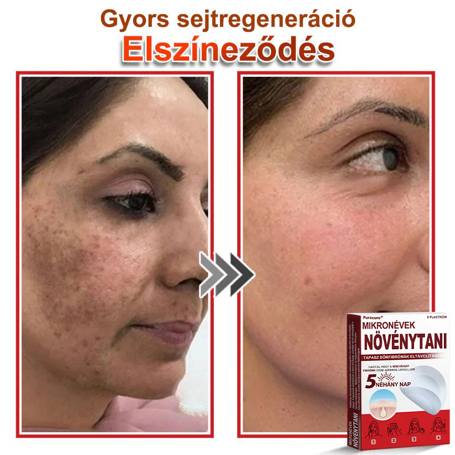 ✨PuraCure® Mikro-tűs botanikai bőrnövedék-eltávolító ✅✅Készült Magyarországon