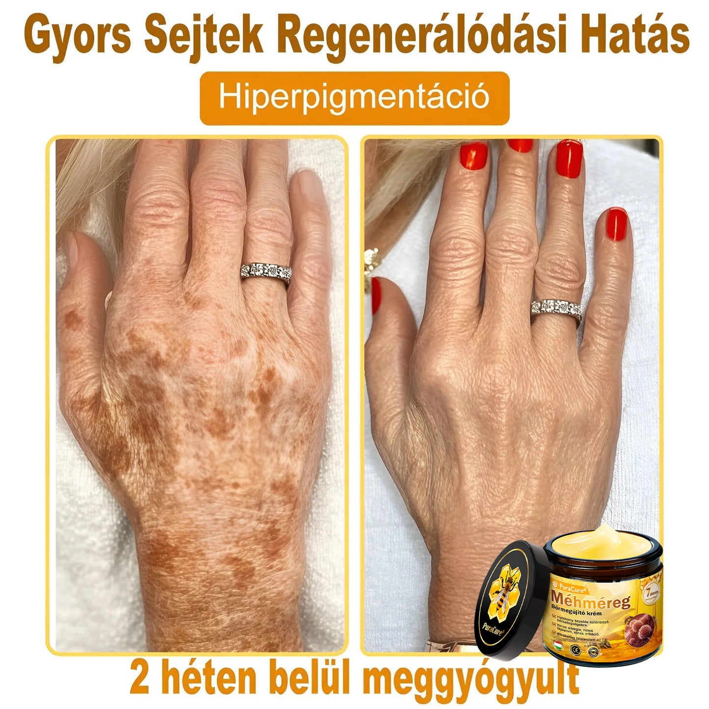 🔥🔥  𝐏𝐮𝐫𝐚𝐂𝐮𝐫𝐞® 𝐌é𝐡𝐦é𝐫𝐞𝐠 𝐁ő𝐫 𝐇𝐞𝐥𝐲𝐫𝐞á𝐥𝐥í𝐭ó 𝐊𝐫é𝐦 (👨‍⚕‍𝐂𝐄 𝐓𝐚𝐧ú𝐬í𝐭𝐯á𝐧𝐲)👍✅