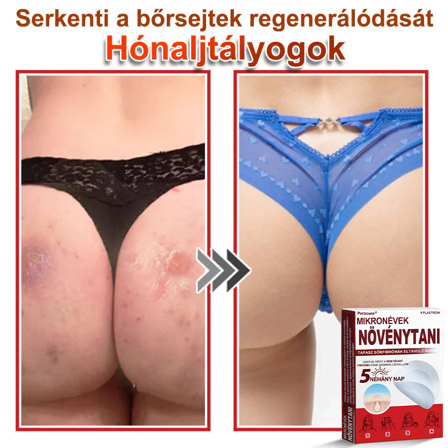✨PuraCure® Mikro-tűs botanikai bőrnövedék-eltávolító ✅✅Készült Magyarországon