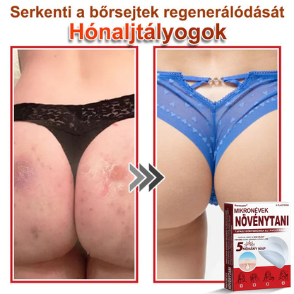 ✨PuraCure® Mikro-tűs botanikai bőrnövedék-eltávolító ✅✅Készült Magyarországon