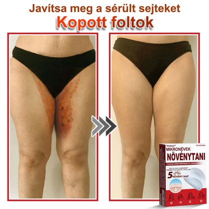 🧑‍⚕️Voilaist® Mikro-tűs botanikai bőrnövedék-eltávolító ✅✅Készült Magyarországon