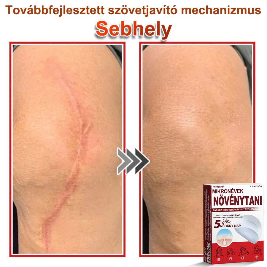 ✨PuraCure® Mikro-tűs botanikai bőrnövedék-eltávolító ✅✅Készült Magyarországon