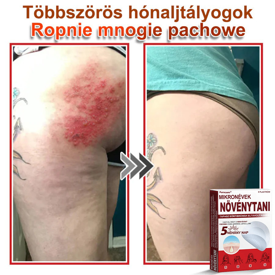 ✨PuraCure® Mikro-tűs botanikai bőrnövedék-eltávolító ✅✅Készült Magyarországon