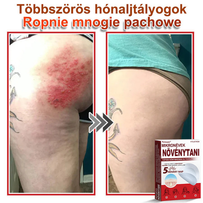 ✨PuraCure® Mikro-tűs botanikai bőrnövedék-eltávolító ✅✅Készült Magyarországon