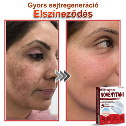 🧑‍⚕️Voilaist® Mikro-tűs botanikai bőrnövedék-eltávolító ✅✅Készült Magyarországon
