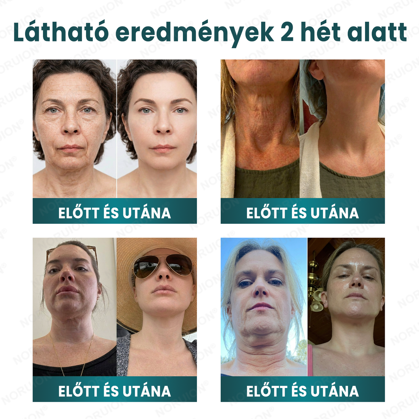 👨‍⚕️Bőrgyógyászok által ajánlott ✨ NORUION® Q10 x Növényi Nano Exoszóma Haladó Ránctalanító Krém
