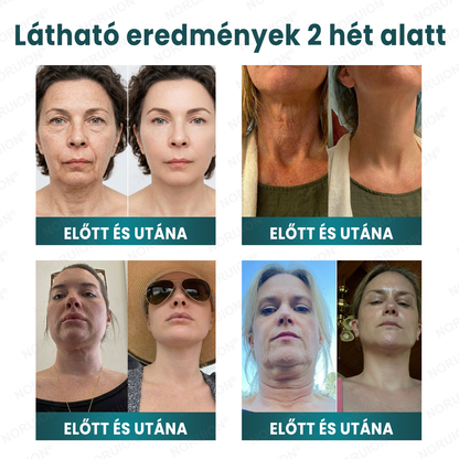 👨‍⚕️Bőrgyógyászok által ajánlott ✨ NORUION® Q10 x Növényi Nano Exoszóma Haladó Ránctalanító Krém