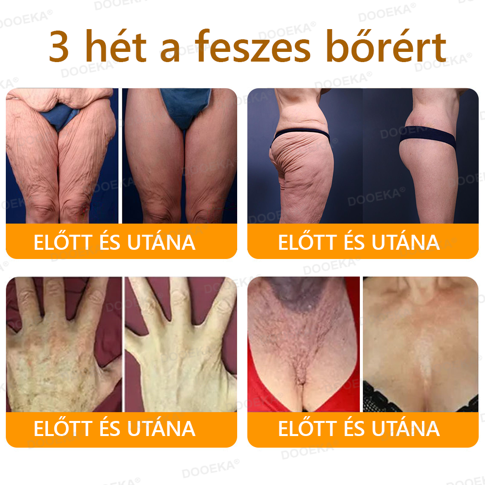 ✨OGYÉI által jóváhagyva: DOOEKA® Méhméreg Bőrmegújító Krém — 🔥Korlátozott ideig 70% kedvezmény🔥