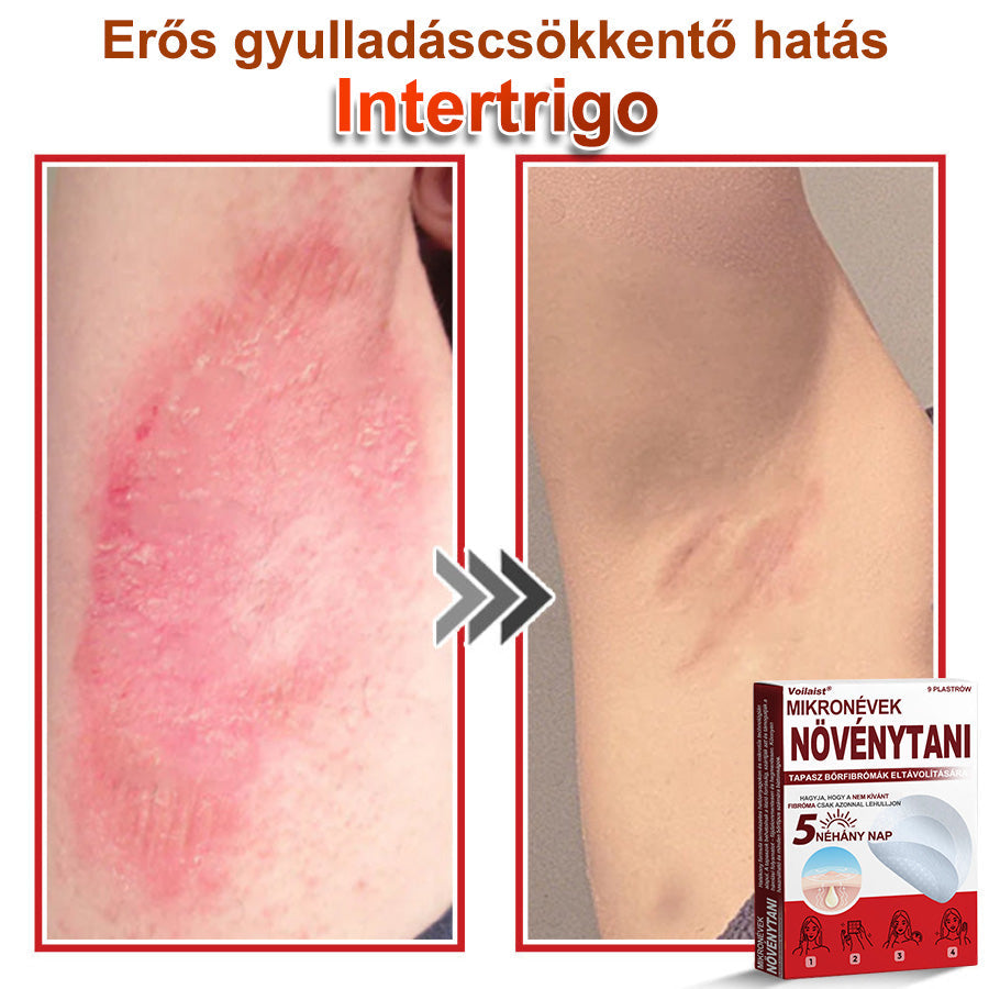 🧑‍⚕️Voilaist® Mikro-tűs botanikai bőrnövedék-eltávolító ✅✅Készült Magyarországon