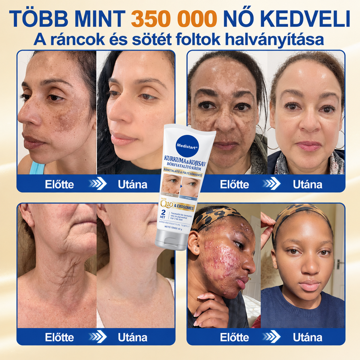 🧑‍⚕️Medistart® 𝐊𝐮𝐫𝐤𝐮𝐦𝐚 × 𝐊𝐨𝐣𝐢𝐧𝐬𝐚𝐯 𝐄́𝐣𝐬𝐳𝐚𝐤𝐚𝐢 Bőrfiatalító 𝐊𝐫𝐞́𝐦— 𝐇𝐚𝐥𝐯𝐚́𝐧𝐲𝐢́𝐭𝐬𝐝 𝐚 𝐦𝐚𝐤𝐚𝐜𝐬 𝐬𝐨̈𝐭𝐞́𝐭 𝐟𝐨𝐥𝐭𝐨𝐤𝐚𝐭 𝐞́𝐬 𝐬𝐢𝐦𝐢́𝐭𝐬𝐝 𝐤𝐢 𝐚 𝐥𝐚́𝐭𝐡𝐚𝐭𝐨́ 𝐫𝐚́𝐧𝐜𝐨𝐤𝐚𝐭 𝐚𝐥𝐯𝐚́𝐬 𝐤𝐨̈𝐳𝐛𝐞𝐧 🌙 ✅ 𝐄́𝐣𝐬𝐳𝐚𝐤𝐚́𝐧𝐤𝐞́𝐧𝐭 𝐞𝐠𝐲 𝐥𝐞́𝐩𝐞́𝐬 · 𝐋𝐚́𝐭𝐡𝐚𝐭𝐨́ 𝐯𝐚́𝐥𝐭𝐨𝐳𝐚́𝐬 𝟕 𝐞́𝐣𝐬𝐳𝐚𝐤𝐚 𝐚𝐥𝐚𝐭𝐭 💯