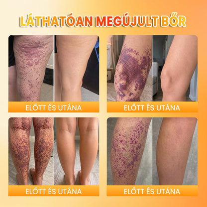 👉100K+ ELADVA -🧑‍⚕️PuraCure® méhpempő véraláfutás-javító és bőrerősítő krém (👍✅𝐂𝐄 𝐓𝐚𝐧ú𝐬í𝐭𝐯á𝐧𝐲)