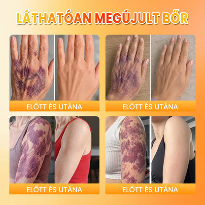 👉100K+ ELADVA -🧑‍⚕️PuraCure® méhpempő véraláfutás-javító és bőrerősítő krém (👍✅𝐂𝐄 𝐓𝐚𝐧ú𝐬í𝐭𝐯á𝐧𝐲)