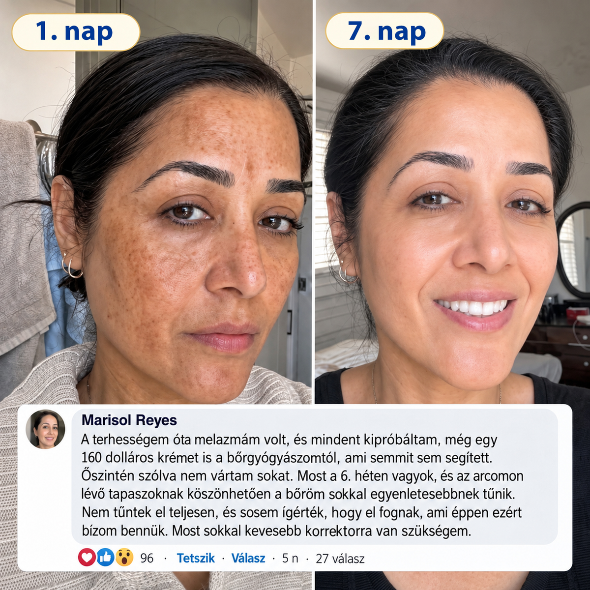 🧑‍⚕️Medistart® 𝐊𝐮𝐫𝐤𝐮𝐦𝐚 × 𝐊𝐨𝐣𝐢𝐧𝐬𝐚𝐯 𝐄́𝐣𝐬𝐳𝐚𝐤𝐚𝐢 Bőrfiatalító 𝐊𝐫𝐞́𝐦— 𝐇𝐚𝐥𝐯𝐚́𝐧𝐲𝐢́𝐭𝐬𝐝 𝐚 𝐦𝐚𝐤𝐚𝐜𝐬 𝐬𝐨̈𝐭𝐞́𝐭 𝐟𝐨𝐥𝐭𝐨𝐤𝐚𝐭 𝐞́𝐬 𝐬𝐢𝐦𝐢́𝐭𝐬𝐝 𝐤𝐢 𝐚 𝐥𝐚́𝐭𝐡𝐚𝐭𝐨́ 𝐫𝐚́𝐧𝐜𝐨𝐤𝐚𝐭 𝐚𝐥𝐯𝐚́𝐬 𝐤𝐨̈𝐳𝐛𝐞𝐧 🌙 ✅ 𝐄́𝐣𝐬𝐳𝐚𝐤𝐚́𝐧𝐤𝐞́𝐧𝐭 𝐞𝐠𝐲 𝐥𝐞́𝐩𝐞́𝐬 · 𝐋𝐚́𝐭𝐡𝐚𝐭𝐨́ 𝐯𝐚́𝐥𝐭𝐨𝐳𝐚́𝐬 𝟕 𝐞́𝐣𝐬𝐳𝐚𝐤𝐚 𝐚𝐥𝐚𝐭𝐭 💯