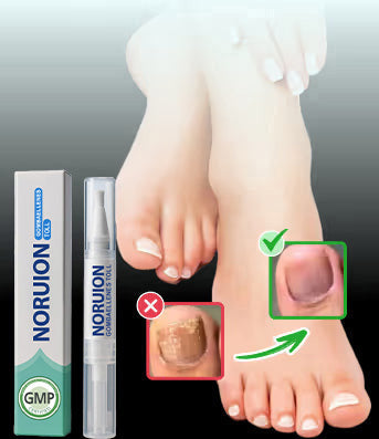 🦶NORUION körömméregtelenítő toll - Természetes megoldás a körömgomba végleges eltávolítására ✨ Nincs szégyen, nincs vegyszer. Látható javulás*🔥