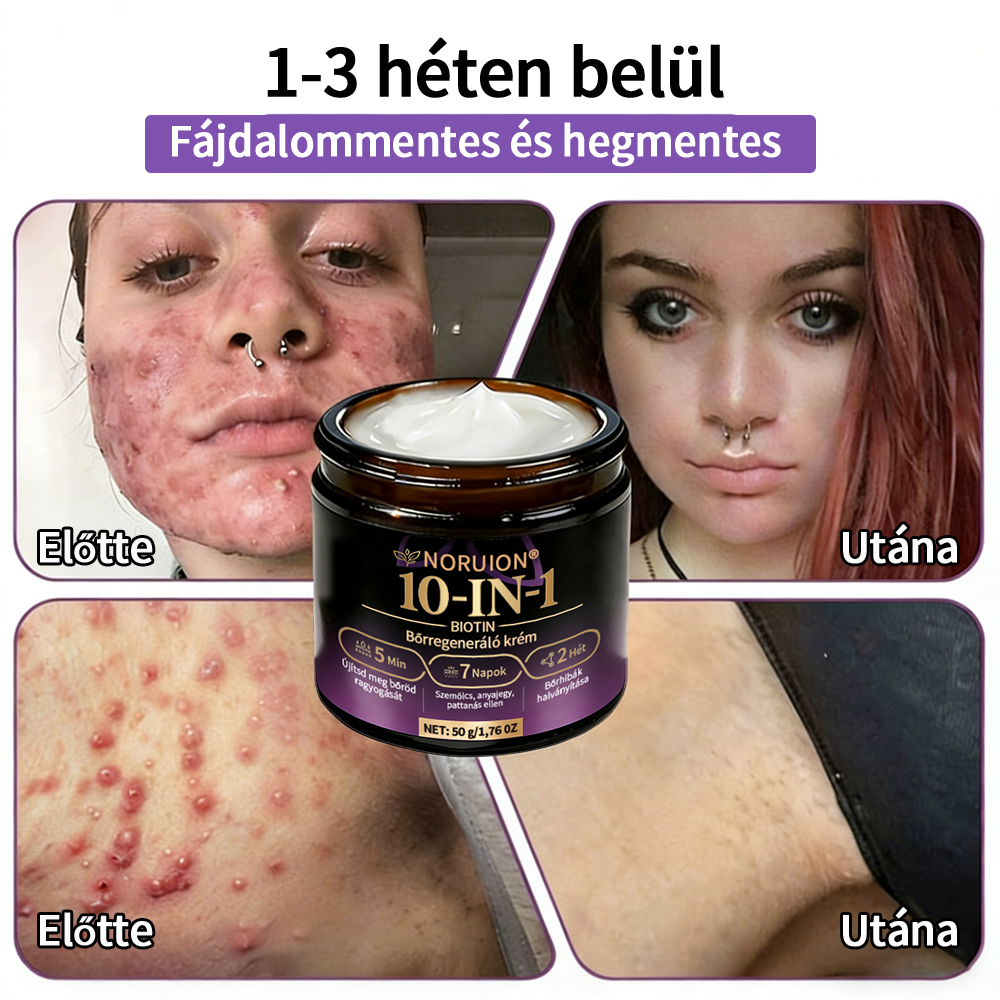 ✨ NORUION® Biotin 10 az 1-ben Bőrmegújító Krém  (👨‍⚕‍CE Tanúsítvány)👍✅ Magyar fejlesztés, magyarországi gyártás és szállítás