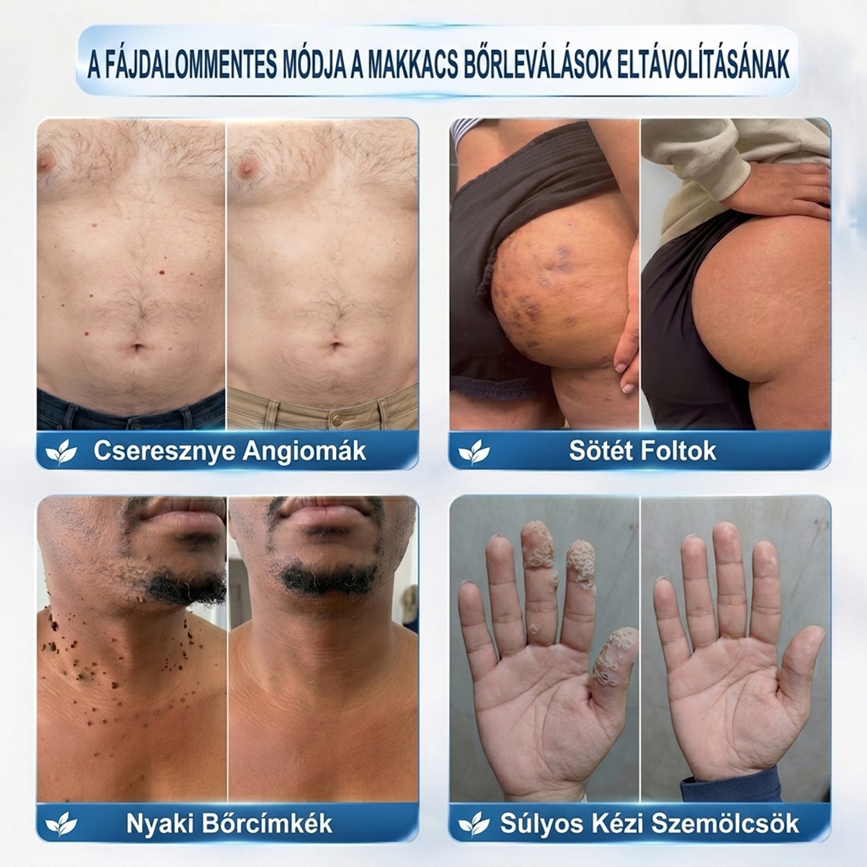 ✨𝐏𝐮𝐫𝐚𝐂𝐮𝐫𝐞® 𝐌𝐢𝐤𝐫𝐨-𝐭ű𝐬 𝐛𝐨𝐭𝐚𝐧𝐢𝐤𝐚𝐢 𝐛ő𝐫𝐧ö𝐯𝐞𝐝é𝐤-𝐞𝐥𝐭á𝐯𝐨𝐥í𝐭ó ✅✅𝐊é𝐬𝐳ü𝐥𝐭 𝐌𝐚𝐠𝐲𝐚𝐫𝐨𝐫𝐬𝐳á𝐠𝐨𝐧