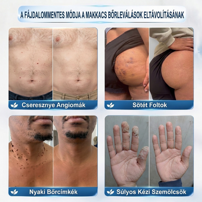 ✨𝐏𝐮𝐫𝐚𝐂𝐮𝐫𝐞® 𝐌𝐢𝐤𝐫𝐨-𝐭ű𝐬 𝐛𝐨𝐭𝐚𝐧𝐢𝐤𝐚𝐢 𝐛ő𝐫𝐧ö𝐯𝐞𝐝é𝐤-𝐞𝐥𝐭á𝐯𝐨𝐥í𝐭ó ✅✅𝐊é𝐬𝐳ü𝐥𝐭 𝐌𝐚𝐠𝐲𝐚𝐫𝐨𝐫𝐬𝐳á𝐠𝐨𝐧