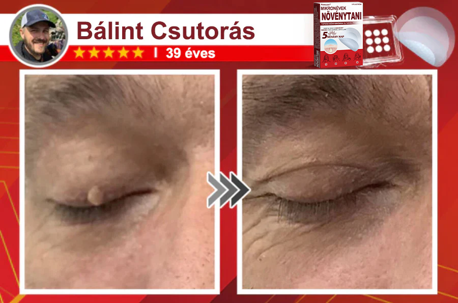 ✨PuraCure® Mikro-tűs botanikai bőrnövedék-eltávolító ✅✅Készült Magyarországon