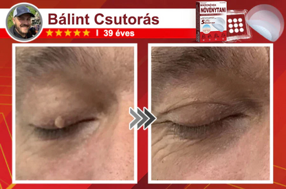 ✨PuraCure® Mikro-tűs botanikai bőrnövedék-eltávolító ✅✅Készült Magyarországon