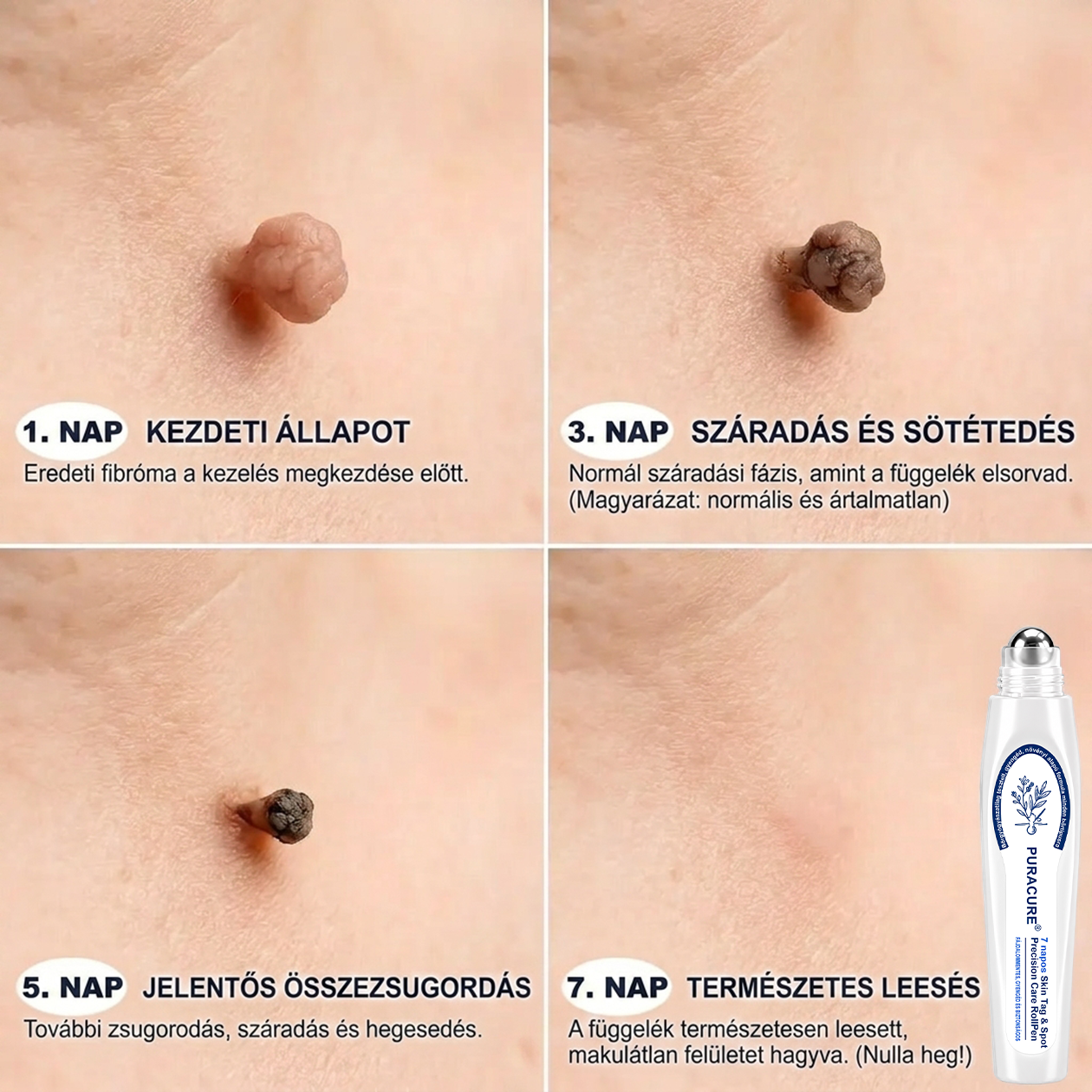 👩‍⚕️PuraCure®  7 Napos Bőrkinövés- és Anyajegyápoló Roller – Fájdalommentes, Hegmentes Bőrhibák Ellen
