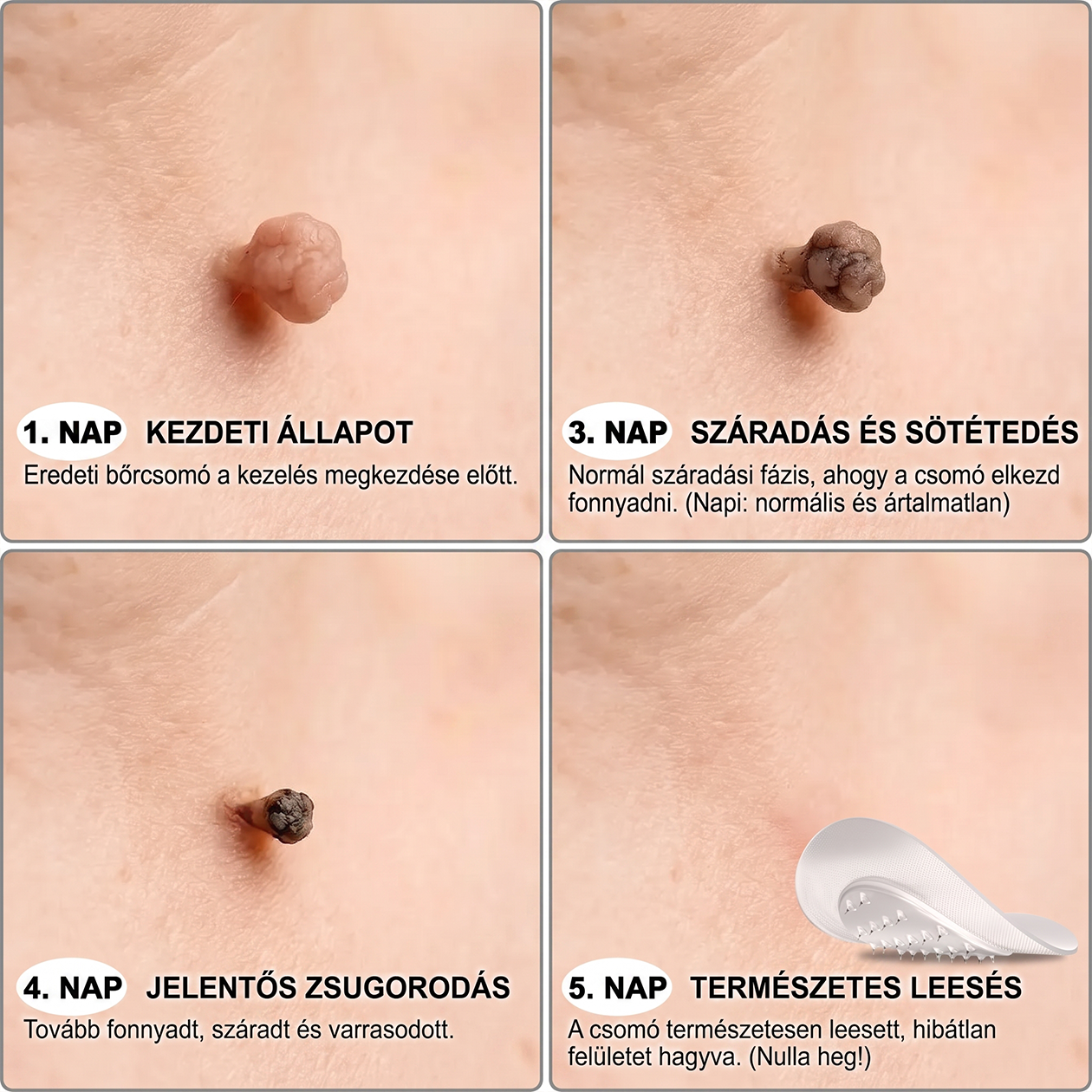 ✨𝐏𝐮𝐫𝐚𝐂𝐮𝐫𝐞® 𝐌𝐢𝐤𝐫𝐨-𝐭ű𝐬 𝐛𝐨𝐭𝐚𝐧𝐢𝐤𝐚𝐢 𝐛ő𝐫𝐧ö𝐯𝐞𝐝é𝐤-𝐞𝐥𝐭á𝐯𝐨𝐥í𝐭ó ✅✅𝐊é𝐬𝐳ü𝐥𝐭 𝐌𝐚𝐠𝐲𝐚𝐫𝐨𝐫𝐬𝐳á𝐠𝐨𝐧