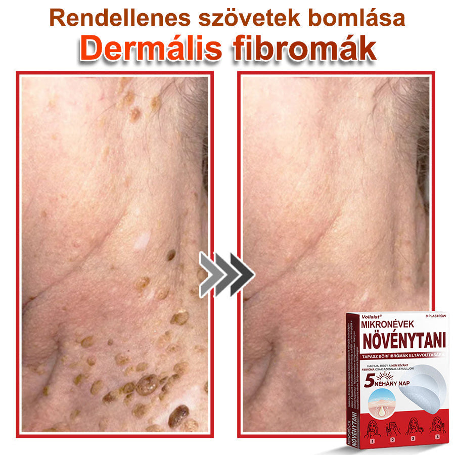 🧑‍⚕️Voilaist® Mikro-tűs botanikai bőrnövedék-eltávolító ✅✅Készült Magyarországon