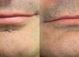🧑‍⚕️ PuraCure® 2 az 1-ben mikrotűs és hidrokolloid tapasz🍀 | Kiálló anyajegyek, aknék, lapos szemölcsök és bőrnövedékek eltávolítására | Segít csökkenteni a ráncokat, hegeket és bőrhibákat | Láthatatlan tapasz az arcra és testre