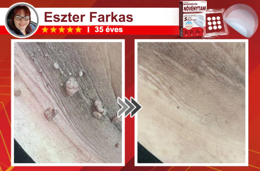 ✨PuraCure® Mikro-tűs botanikai bőrnövedék-eltávolító ✅✅Készült Magyarországon