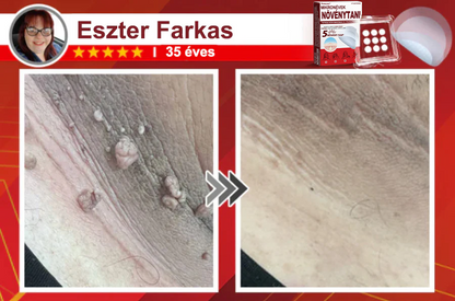 ✨PuraCure® Mikro-tűs botanikai bőrnövedék-eltávolító ✅✅Készült Magyarországon