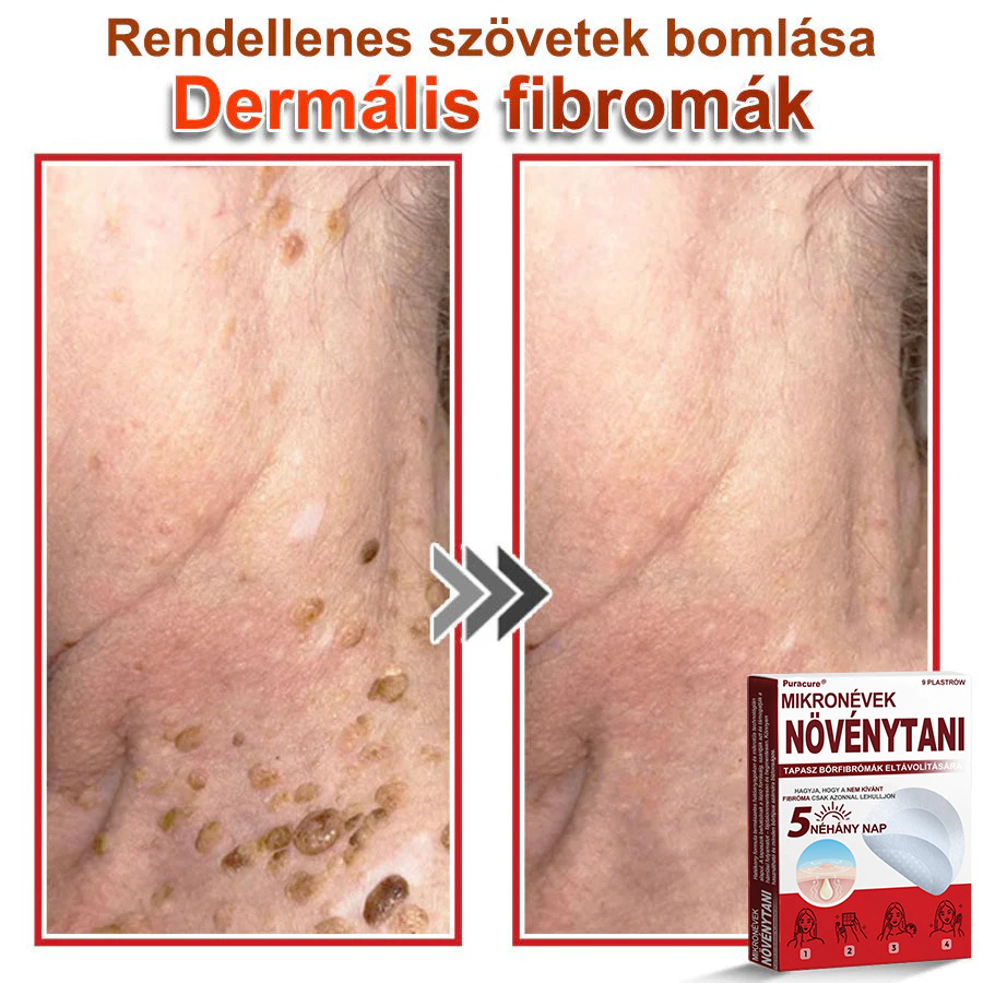 ✨PuraCure® Mikro-tűs botanikai bőrnövedék-eltávolító ✅✅Készült Magyarországon