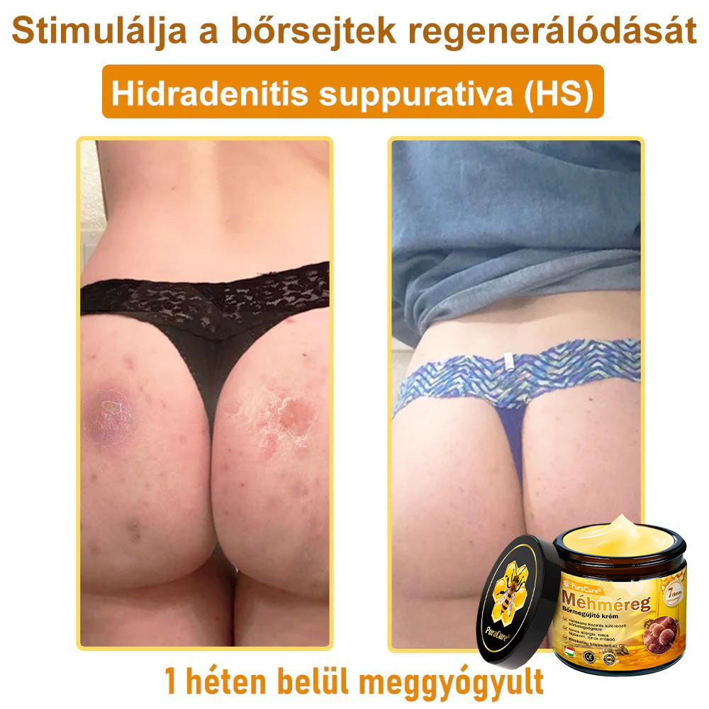 🔥🔥  𝐏𝐮𝐫𝐚𝐂𝐮𝐫𝐞® 𝐌é𝐡𝐦é𝐫𝐞𝐠 𝐁ő𝐫 𝐇𝐞𝐥𝐲𝐫𝐞á𝐥𝐥í𝐭ó 𝐊𝐫é𝐦 (👨‍⚕‍𝐂𝐄 𝐓𝐚𝐧ú𝐬í𝐭𝐯á𝐧𝐲)👍✅