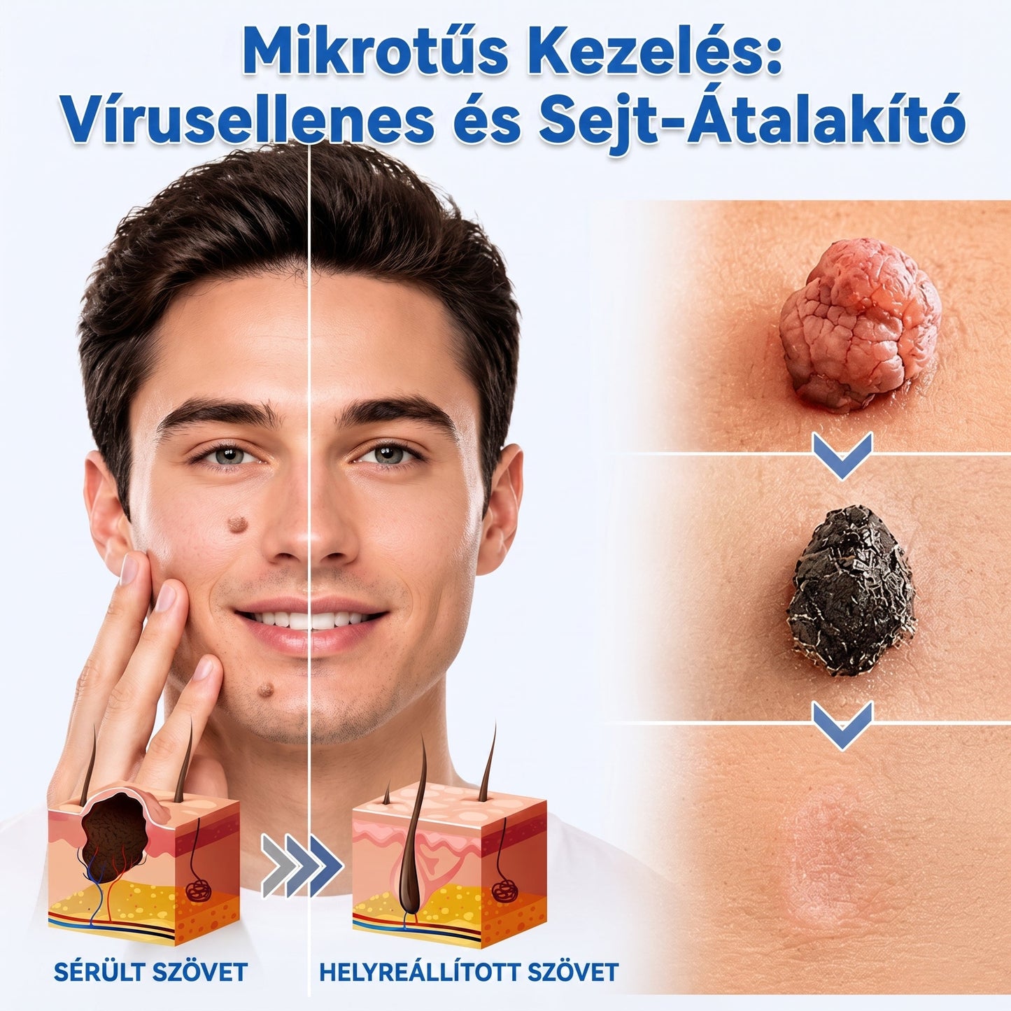 🧑‍⚕️ PuraCure® 2 az 1-ben mikrotűs és hidrokolloid tapasz🍀 | Kiálló anyajegyek, aknék, lapos szemölcsök és bőrnövedékek eltávolítására | Segít csökkenteni a ráncokat, hegeket és bőrhibákat | Láthatatlan tapasz az arcra és testre
