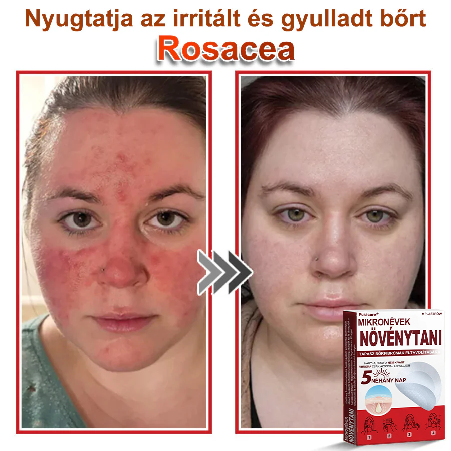 ✨PuraCure® Mikro-tűs botanikai bőrnövedék-eltávolító ✅✅Készült Magyarországon
