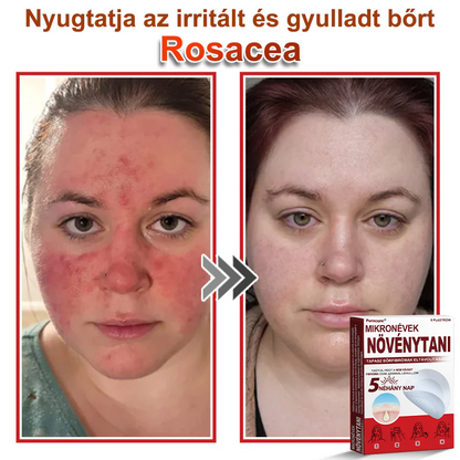✨PuraCure® Mikro-tűs botanikai bőrnövedék-eltávolító ✅✅Készült Magyarországon