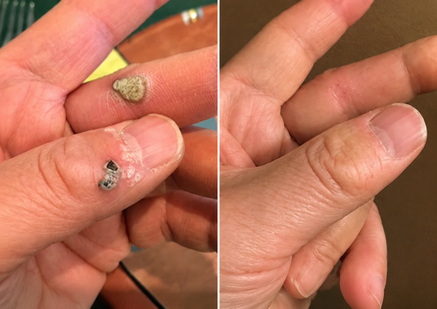 🧑‍⚕️ PuraCure® 2 az 1-ben mikrotűs és hidrokolloid tapasz🍀 | Kiálló anyajegyek, aknék, lapos szemölcsök és bőrnövedékek eltávolítására | Segít csökkenteni a ráncokat, hegeket és bőrhibákat | Láthatatlan tapasz az arcra és testre