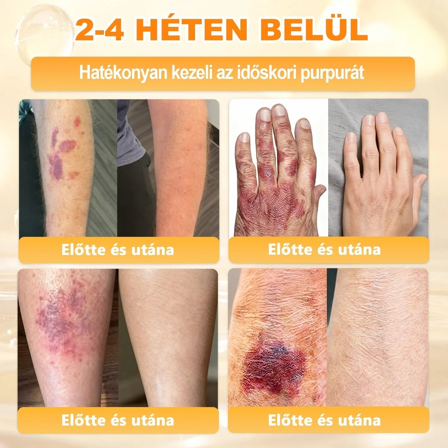 🔥🔥  𝐏𝐮𝐫𝐚𝐂𝐮𝐫𝐞® 𝐌é𝐡𝐦é𝐫𝐞𝐠 𝐁ő𝐫 𝐇𝐞𝐥𝐲𝐫𝐞á𝐥𝐥í𝐭ó 𝐊𝐫é𝐦 (👨‍⚕‍𝐂𝐄 𝐓𝐚𝐧ú𝐬í𝐭𝐯á𝐧𝐲)👍✅