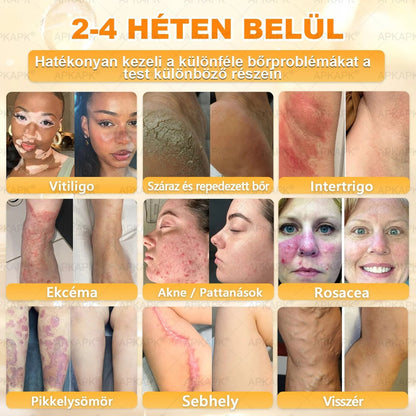 🔥🔥  𝐏𝐮𝐫𝐚𝐂𝐮𝐫𝐞® 𝐌é𝐡𝐦é𝐫𝐞𝐠 𝐁ő𝐫 𝐇𝐞𝐥𝐲𝐫𝐞á𝐥𝐥í𝐭ó 𝐊𝐫é𝐦 (👨‍⚕‍𝐂𝐄 𝐓𝐚𝐧ú𝐬í𝐭𝐯á𝐧𝐲)👍✅