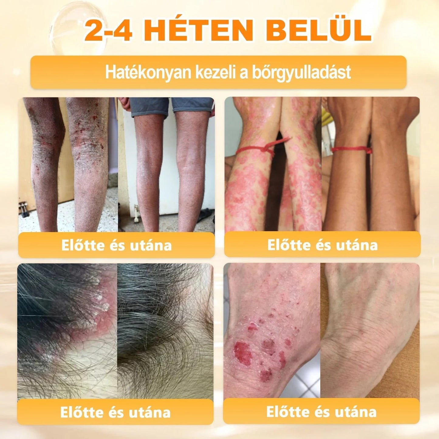 🔥🔥  𝐏𝐮𝐫𝐚𝐂𝐮𝐫𝐞® 𝐌é𝐡𝐦é𝐫𝐞𝐠 𝐁ő𝐫 𝐇𝐞𝐥𝐲𝐫𝐞á𝐥𝐥í𝐭ó 𝐊𝐫é𝐦 (👨‍⚕‍𝐂𝐄 𝐓𝐚𝐧ú𝐬í𝐭𝐯á𝐧𝐲)👍✅
